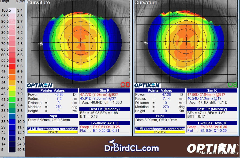 คนไข้ตาแห้ง ได้ลองใส่ corneal RGP แล้วระคายเคืองตามาก ทนไม่ไหว สุดท้าย ...