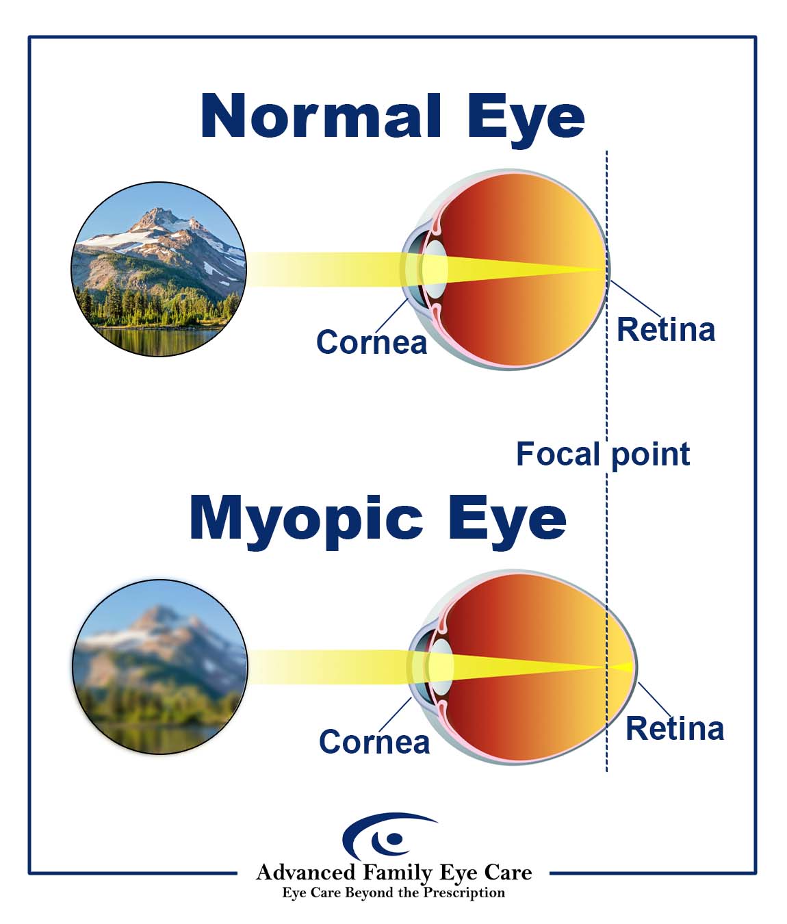 myopia-control-bangkok-thailand-at185-dr-bird