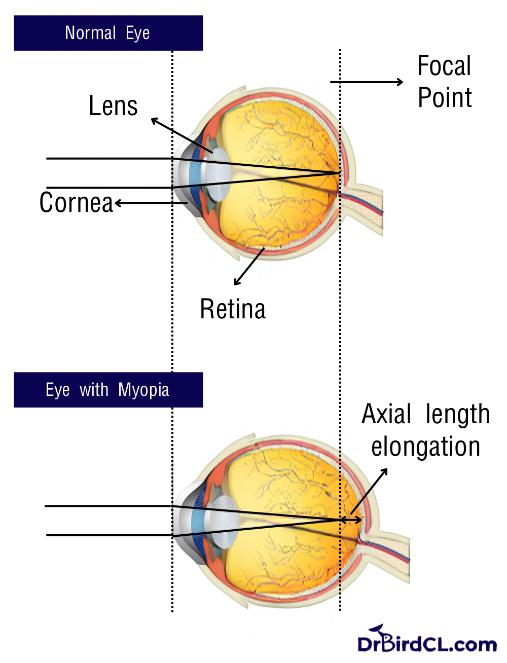 การเปลี่ยนแปลงในลูกตาเมื่อสายตาสั้นเพิ่มขึ้น – Dr Bird
