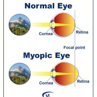 nornal-eye-vs.-eye-with-myopia