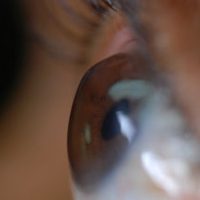 post-lasik-corneal-ectasia-s